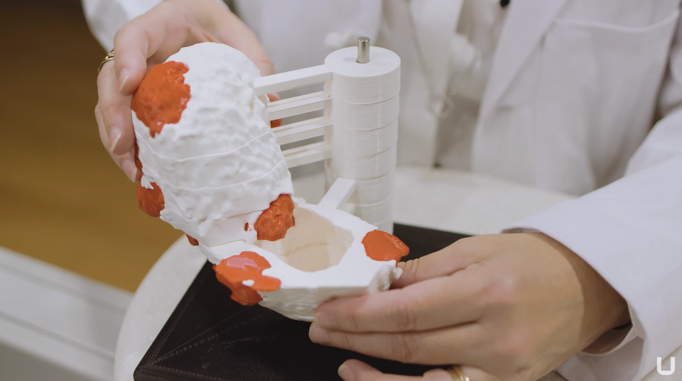 Abington Hospital - Jefferson Health Utilizes 3D Printing in Surgical Planning